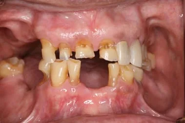loose dentures failed teeth