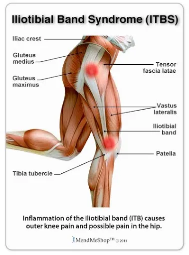 Thera-Band Exercise and Foam Rolling help IT Band Syndrome in Runners -  Performance Health Academy