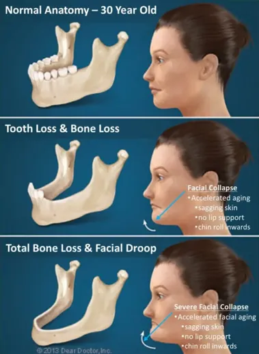 dental implant procedure fort lauderdale fl
