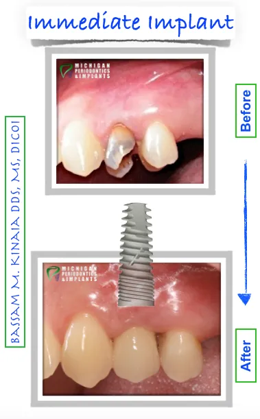 Dental Implants Macomb