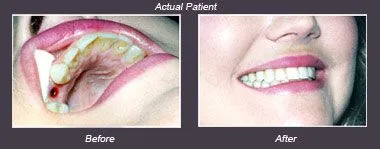 Dental Implant results