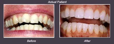 Invisalign Results