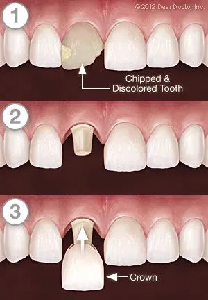 Dental Crowns Step by Step St. Clair Shores, MI & Grosse Pointe Woods, MI