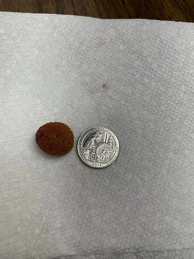 Gizmo Bladder Stone