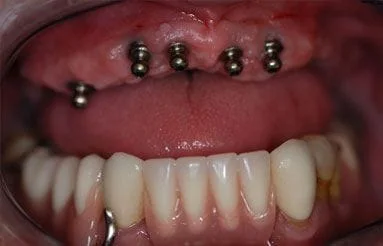 Locator Implant Denture