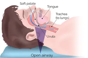 illustration of open airway, Skokie, IL sleep apnea Wilmette, IL and Winnetka, IL