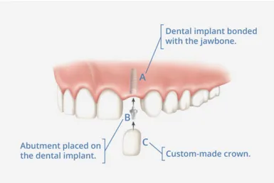 diagram of implant being placed in jawbone, Dental Implants Katy, TX - Olim and Associates