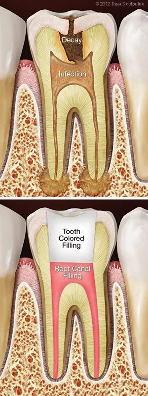 Root Canal Therapy 