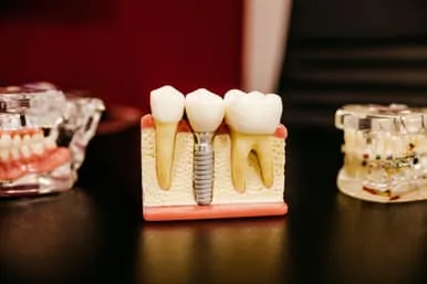 Photograph of model of Dental Implants, Honolulu, HI