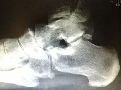 Severe osteoarthritis of the talo-navilcular joint needing fusion with bone graft, claw plate, and screws.