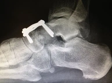 Severe osteoarthritis of the talo-navilcular joint needing fusion with bone graft, claw plate, and screws.
