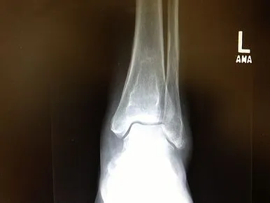 Tibial, fibular, and talar bone cyst treated with bone graft and pediatric blade plate and screws.