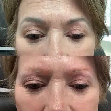 Eyebrows tattoo removal