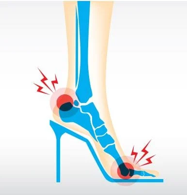 Heel Pain During Pregnancy: Causes & Treatment - ePodiatrists