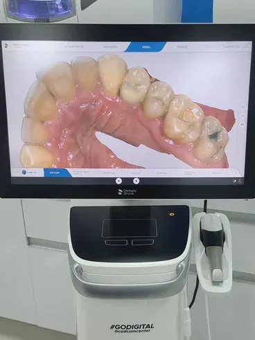 computer screen showing digital impression of a person's lower teeth, dentist New Baltimore, MI