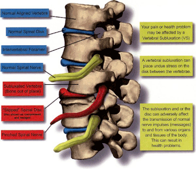 What is a Vertebral Subluxation?