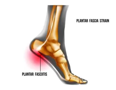 Medical 3D illustration of a foot that suffers from Plantar Fasciitis