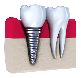 illustration of dental implant embedded in gum tissue next to natural molar tooth, dental implants Philadelphia, PA cosmetic dentistry