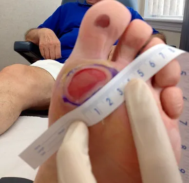 Diabetic Wound Before Dermagraft