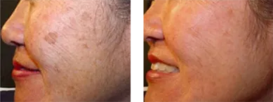 Before and After Intense Pulsed Light Treatment