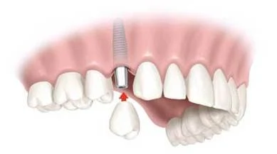 illustration showing arch of teeth with one dental implant replacing a tooth, dental implants Mahwah, NJ