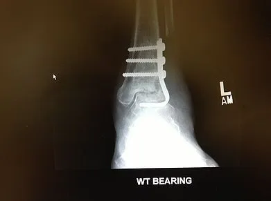 Tibial, fibular, and talar bone cyst treated with bone graft and pediatric blade plate and screws.