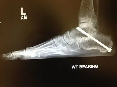 Subtalar joint arthrodesis with large screw.