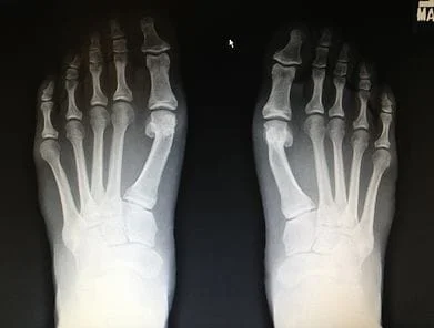 Tailor's bunion correction both feet with small screws.