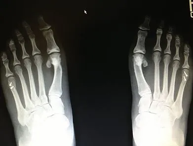 Tailor's bunion correction both feet with small screws.