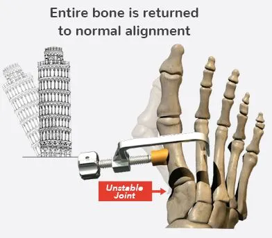 Lapiplasty 3D bunion correction addresses the root problem