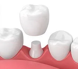 illustration of dental crown being placed over tooth, dentist Windsor Locks, CT dental crowns