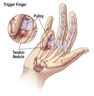 Trigger Finger: Causes, Symptoms, and Treatment Options - Philadelphia Hand  to Shoulder Center