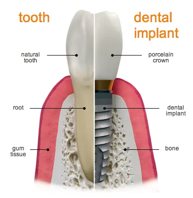 tooth vs implant