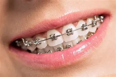 Stainless steel braces