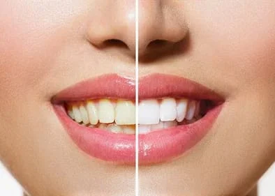 before and after image of woman's teeth, yellowed teeth on left, whiter teeth on right, after professional teeth whitening Seminole, FL dentist