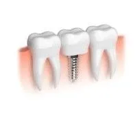 Dental Implants Birmingham, Bloomfield Hills, Royal Oak MI