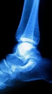 Walnut Creek Podiatrist | Walnut Creek Haglund's Deformity | CA | Brim McMillan-Gordon, D.P.M. |