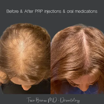PRP Treatment results