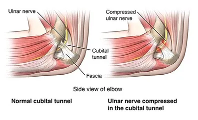 Ulnar Neuropathy – Peripheral Nerve Conditions – The American