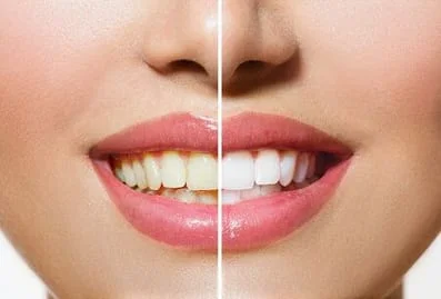 before and after teeth whitening Washington, DC - woman's mouth with yellowed teeth on one half then whiter teeth on other half