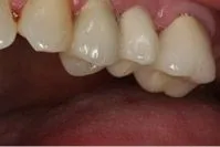 Dental Implants After Portage, MI