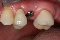 Dental Implants Before Portage, MI