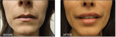 Before & After Of Lip Procedure