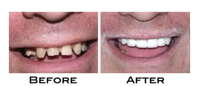 smile makeover