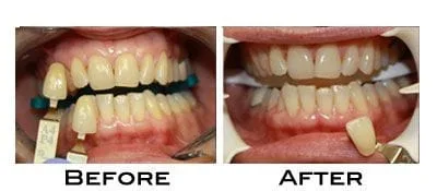 Teeth Whitening Results with Boost whitening system