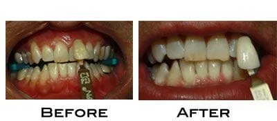 Teeth Whitening Results with Boost whitening system