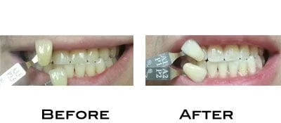 Teeth Whitening Results with Boost whitening system