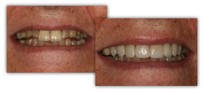 before and after veneers Grand Rapids