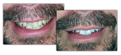 before and after teeth whitening, Grand Rapids