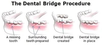 dental_bridge_diagram